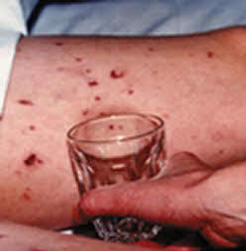 Meningitis rash