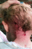 The wounds at the back of little Curtis' head after the attack by a ferret.